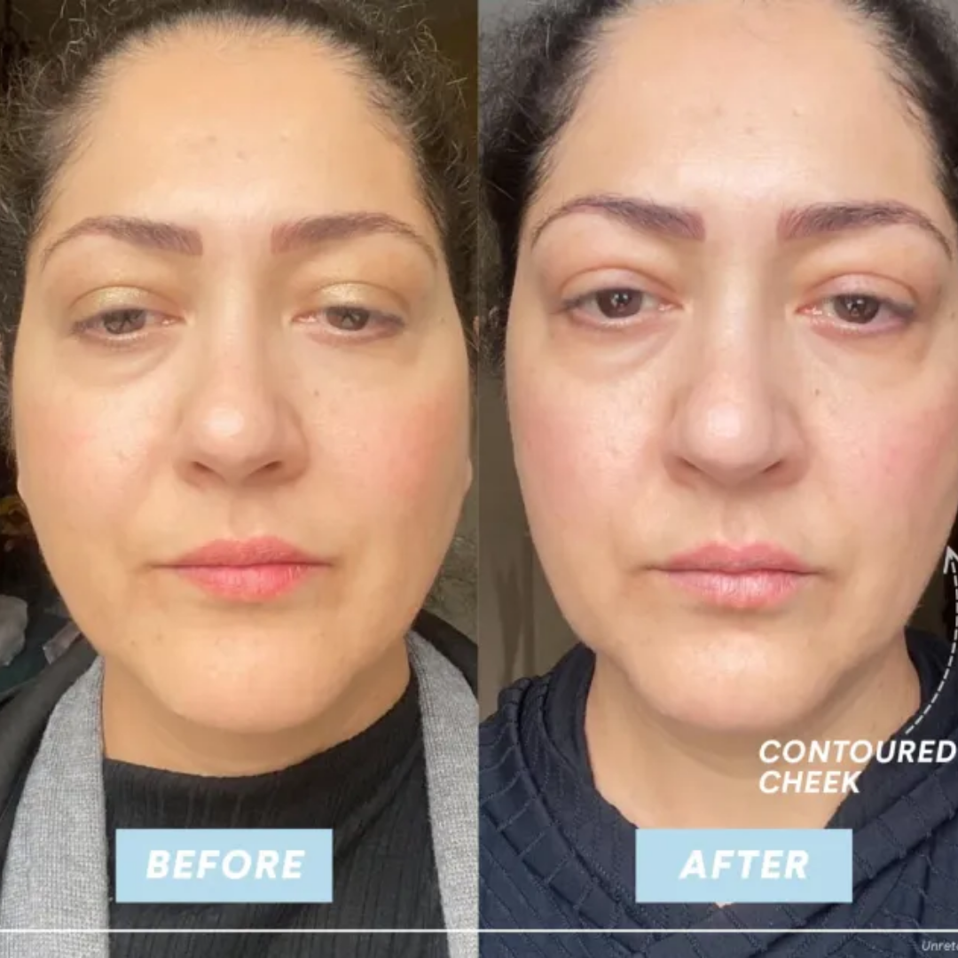 Electra™ Microcurrent Facial Toning Device