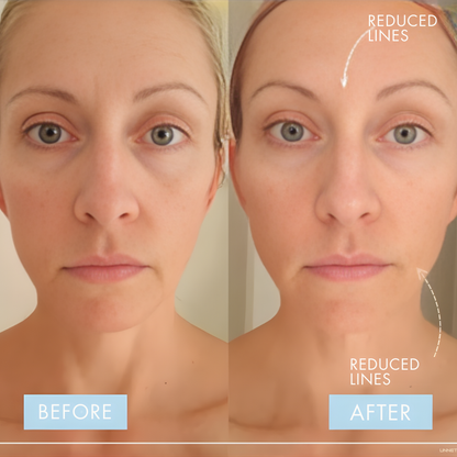 Electra™ Microcurrent Facial Toning Device