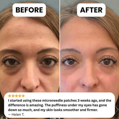 Revita™ Microneedle Glow Patches