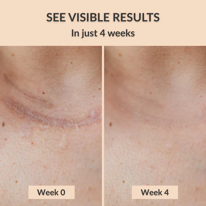 Eterna™ Silicone Healing Strips