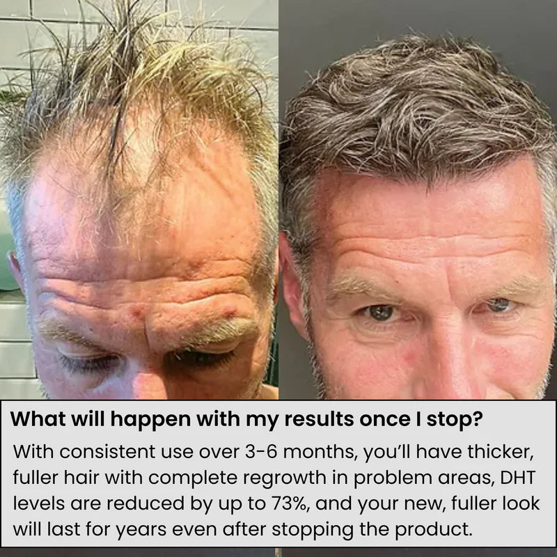 Lexinovo™ Hair Infusion System