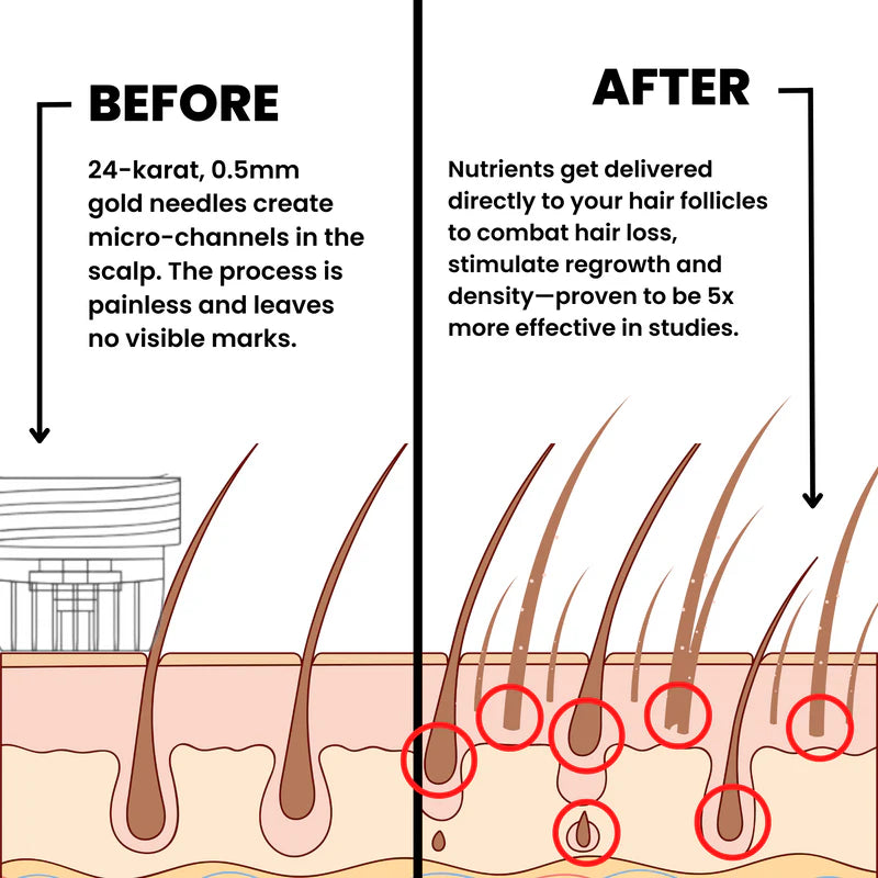 Lexinovo™ Hair Infusion System