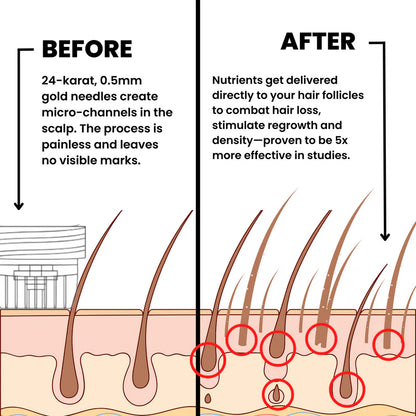 Lexinovo™ Hair Infusion System