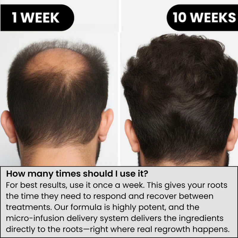 Lexinovo™ Hair Infusion System