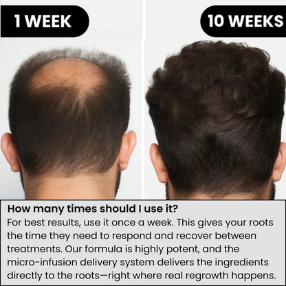 Lexinovo™ Hair Infusion System